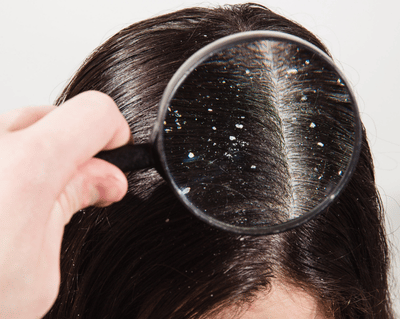 dandruff
