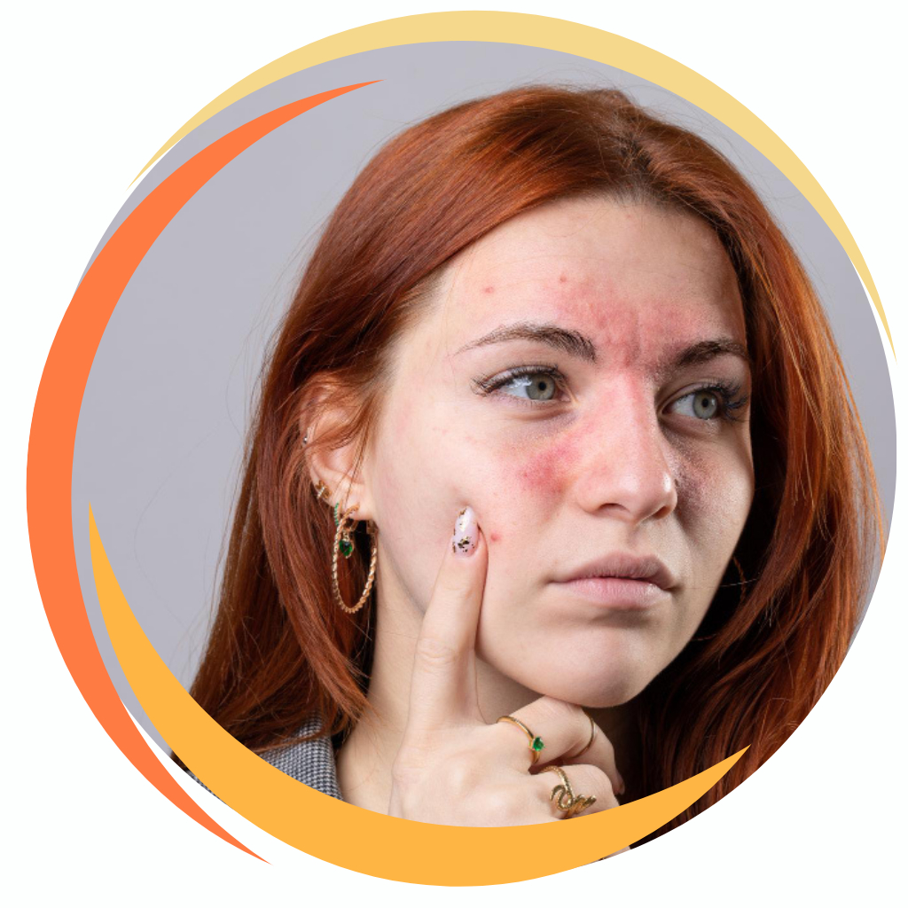 Rosacea