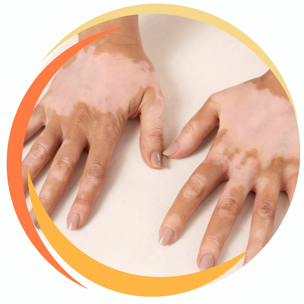 Vitiligo