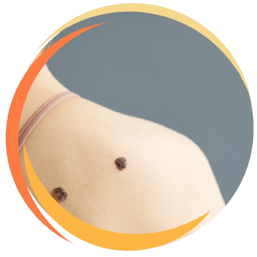 Warts
