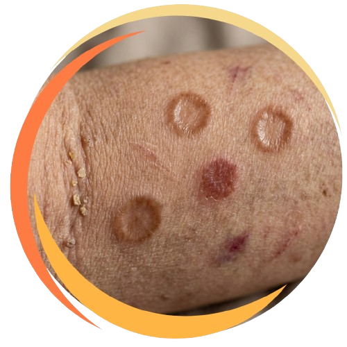 Diabetic Skin