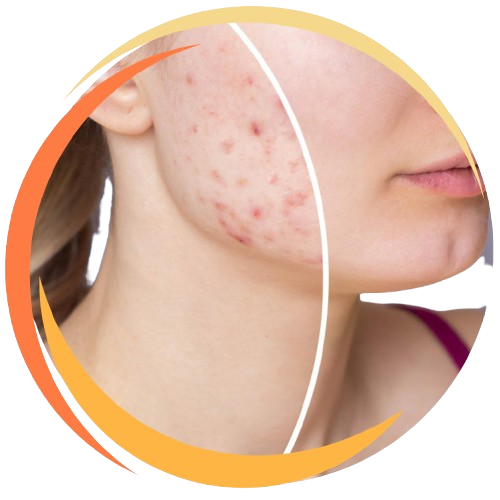 Acne Scar Treatments