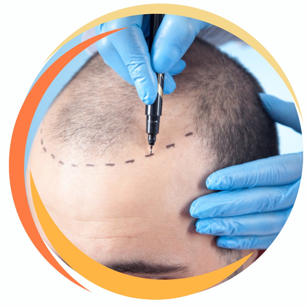 Hair Transplant Services