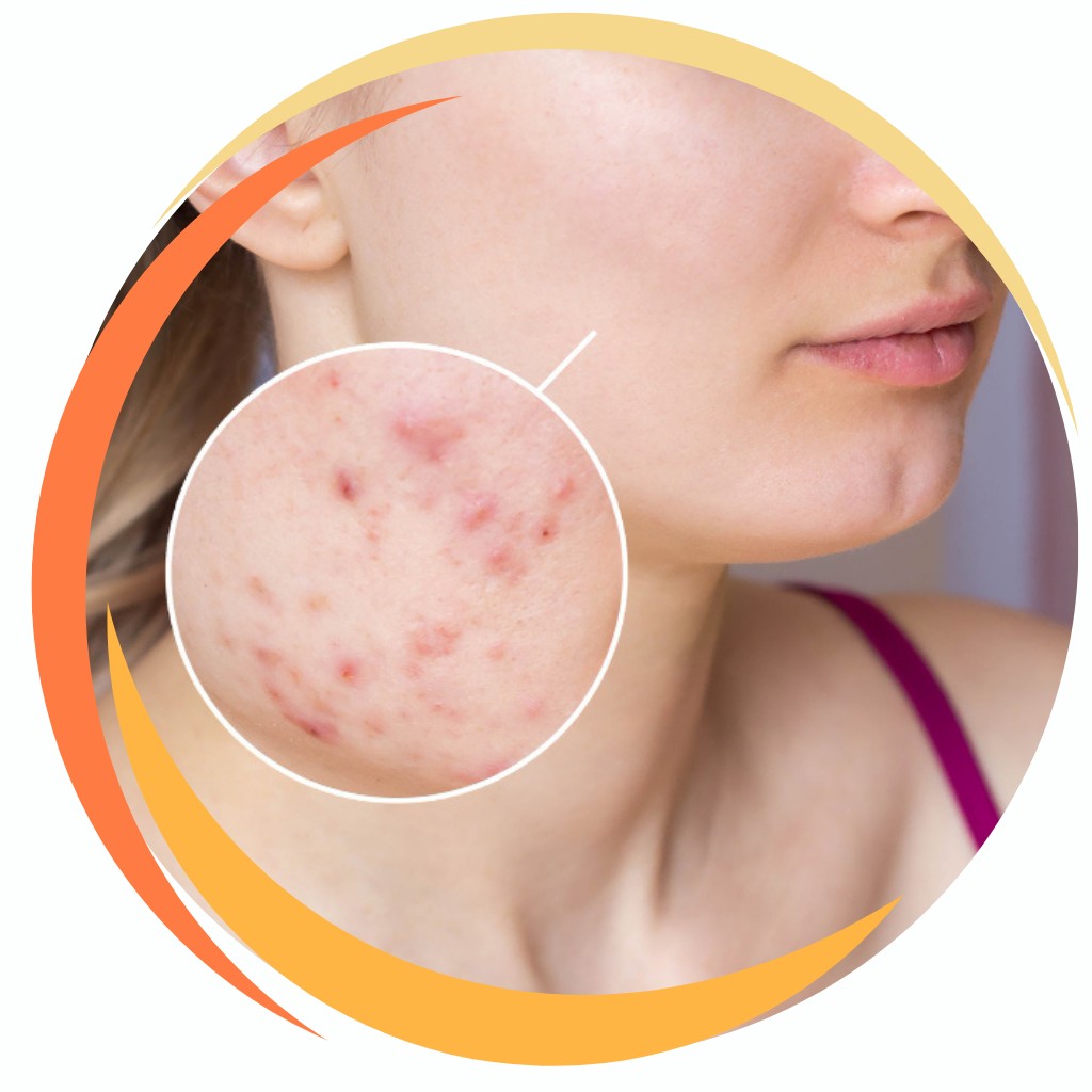 Acne Scars