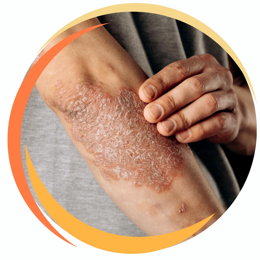 Psoriasis