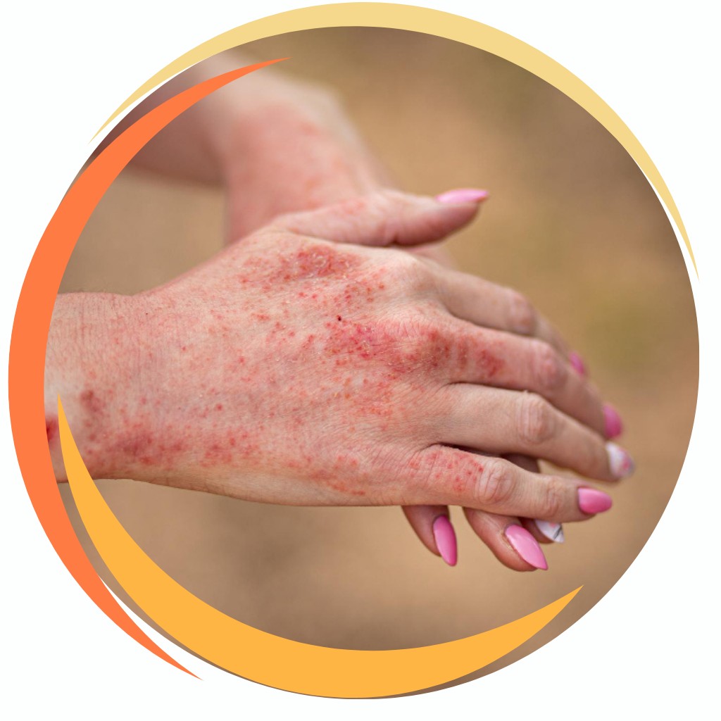 Eczema